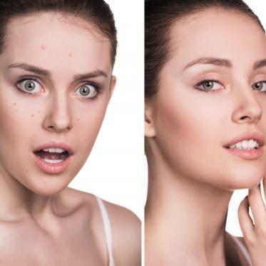 Microbio Skin Tag Remover What To know