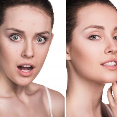 Microbio Skin Tag Remover Benefits Ingredients