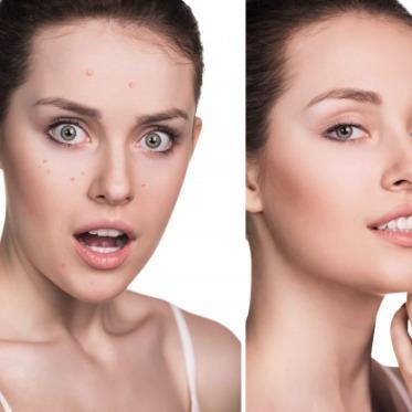 Microbio Skin Tag Remover where to buy