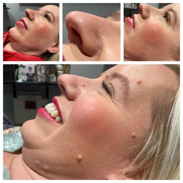 Anus Skin Tag Removal Cream- 100% Safe & Trusted?