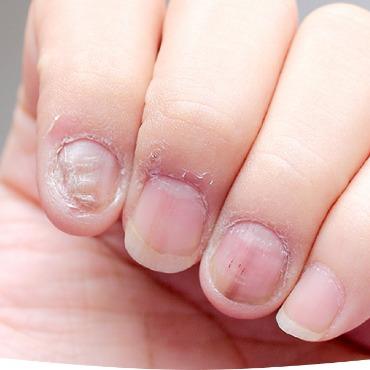 Mycosoothe Review 2024 Nail Health Supplement